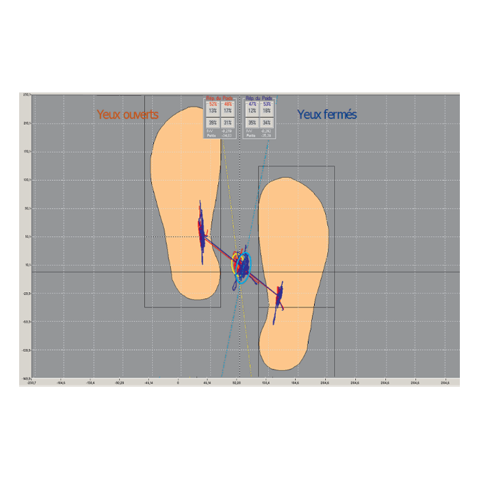 Pedana Stabilometrica Cyber Sabots - Statokinesigrammi